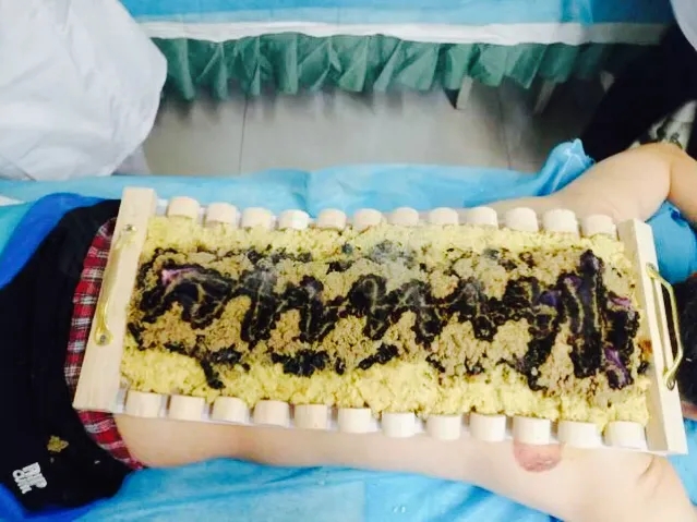 【中医特色】中医特色疗法——督灸