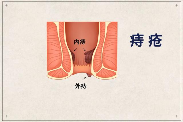 安氏疗法治疗痔疮：媒体报道